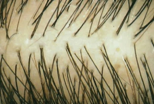 Ejemplo de la condición del cabello antes de usar Folicerin